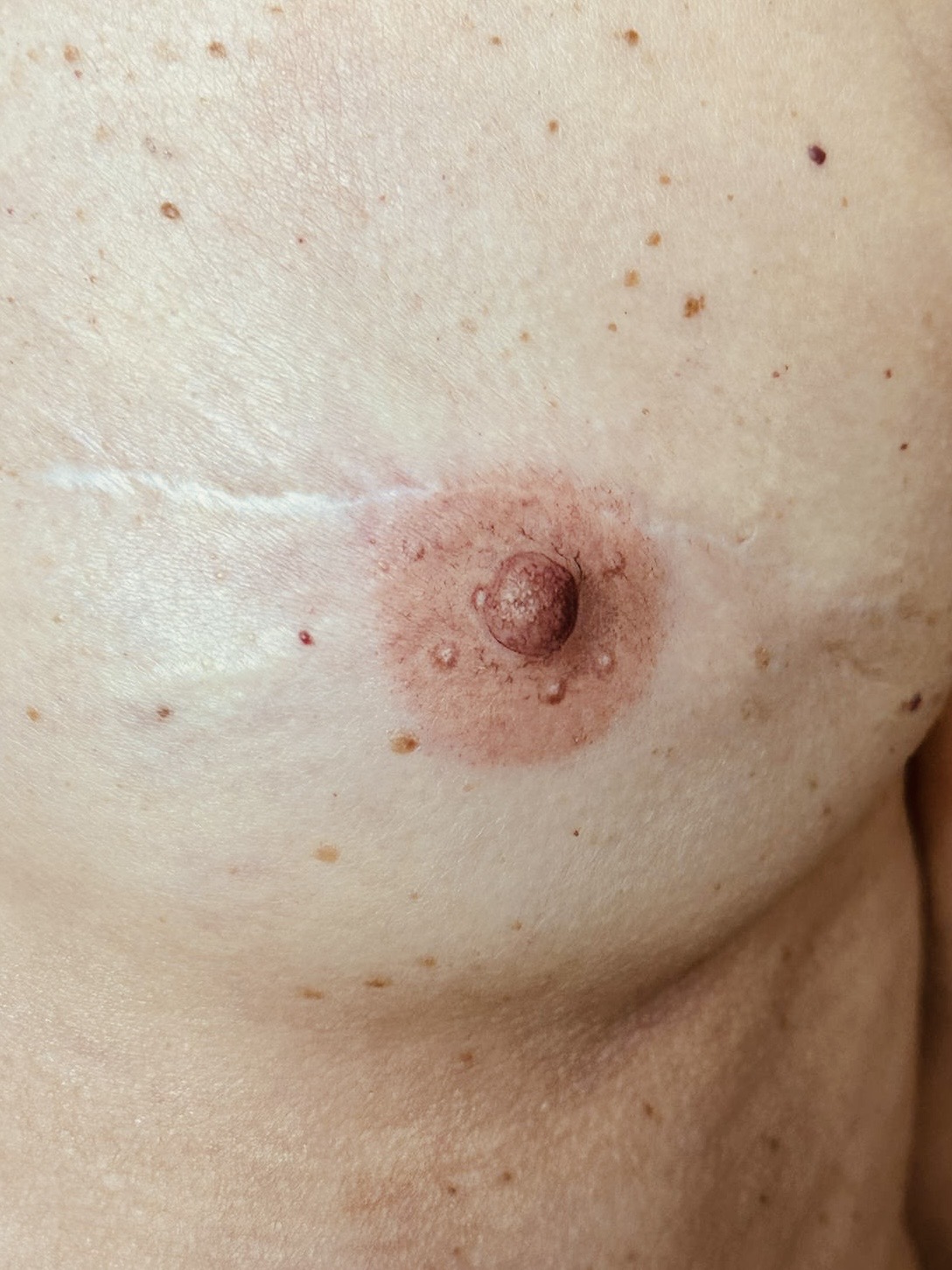 Pigmentation de l'aréole mammaire après chirurgie, travail des nuances en trompe-l'œil, Studio Confidence Marseille